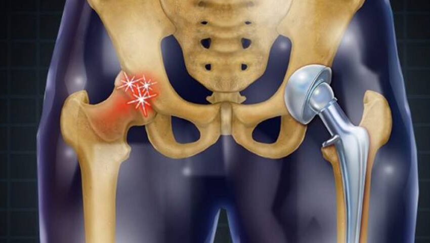 Hip Replacement